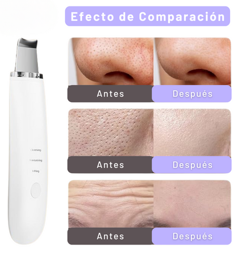Limpiador Ultrasónico ¡Despídete del acné, puntos negros y piel grasa!
